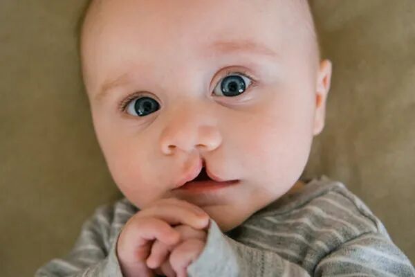 ۴ نوزاد از هر ۱۰۰۰ تولد با شکاف لب متولد می‌شوند؛ جراحی دقیق راه‌حل ترمیمی